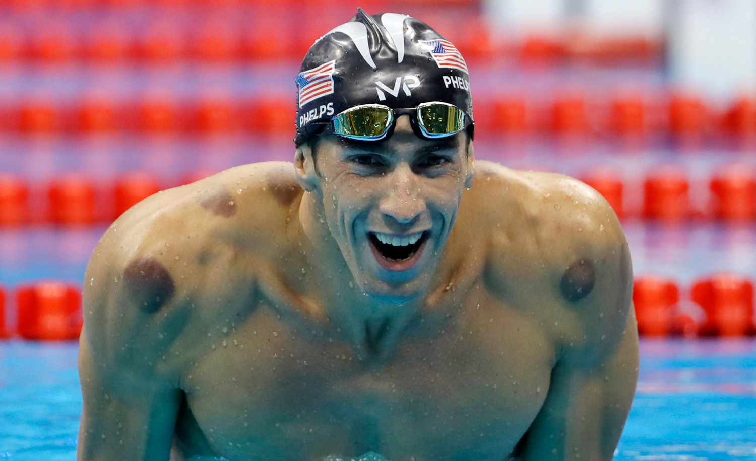 Cupping marks on the shoulders of Michael Phelps as he celebrates winning the gold medal in the men&#8217;s 200-meter butterfly at the 2016 Summer Olympics in Rio de Janeiro, Brazil. AP Photo/David J. Phillip, File.
